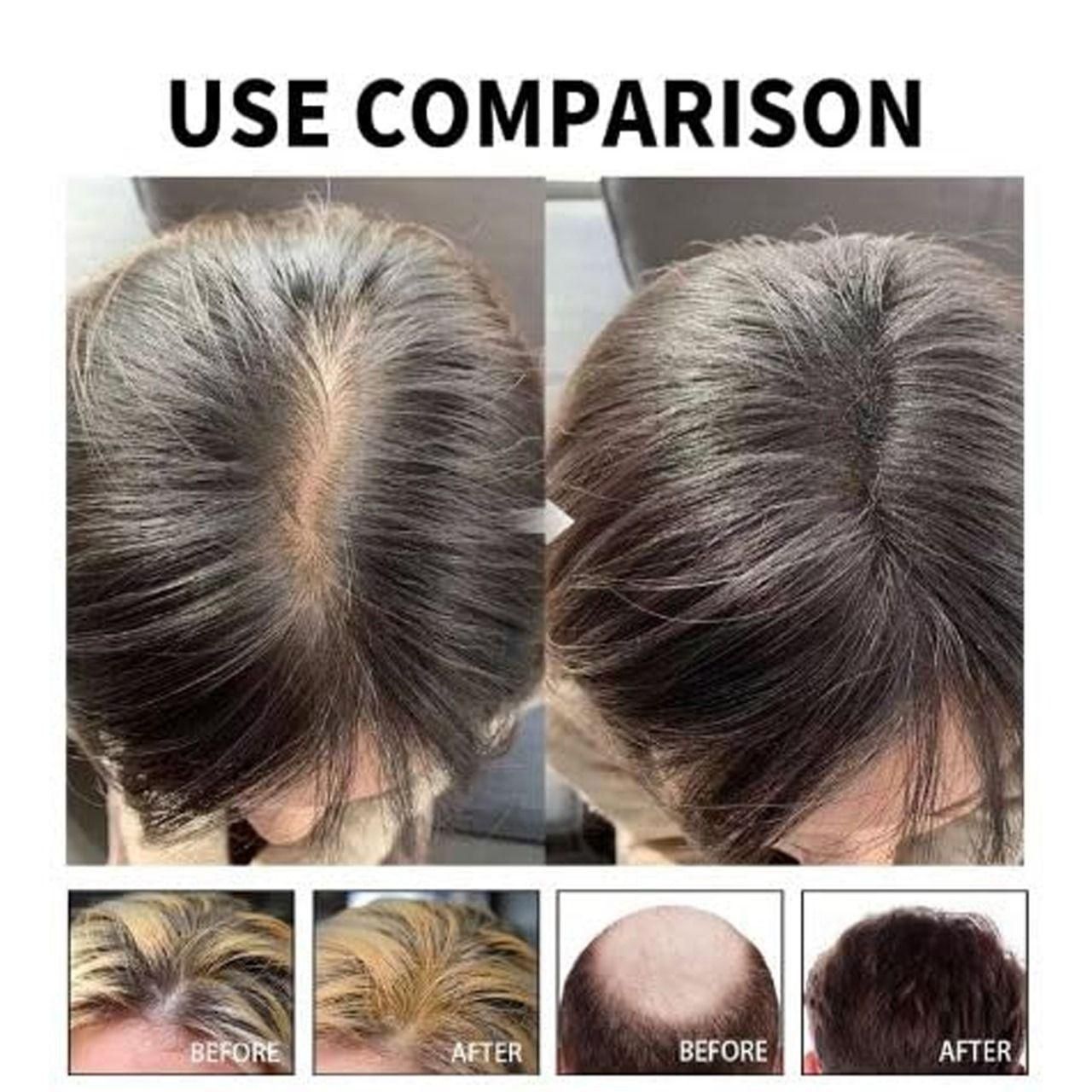 Hair Loss Treatment Serum Made of 34 Ingredients & 15 Herbs 30ml (Pack Of 2)