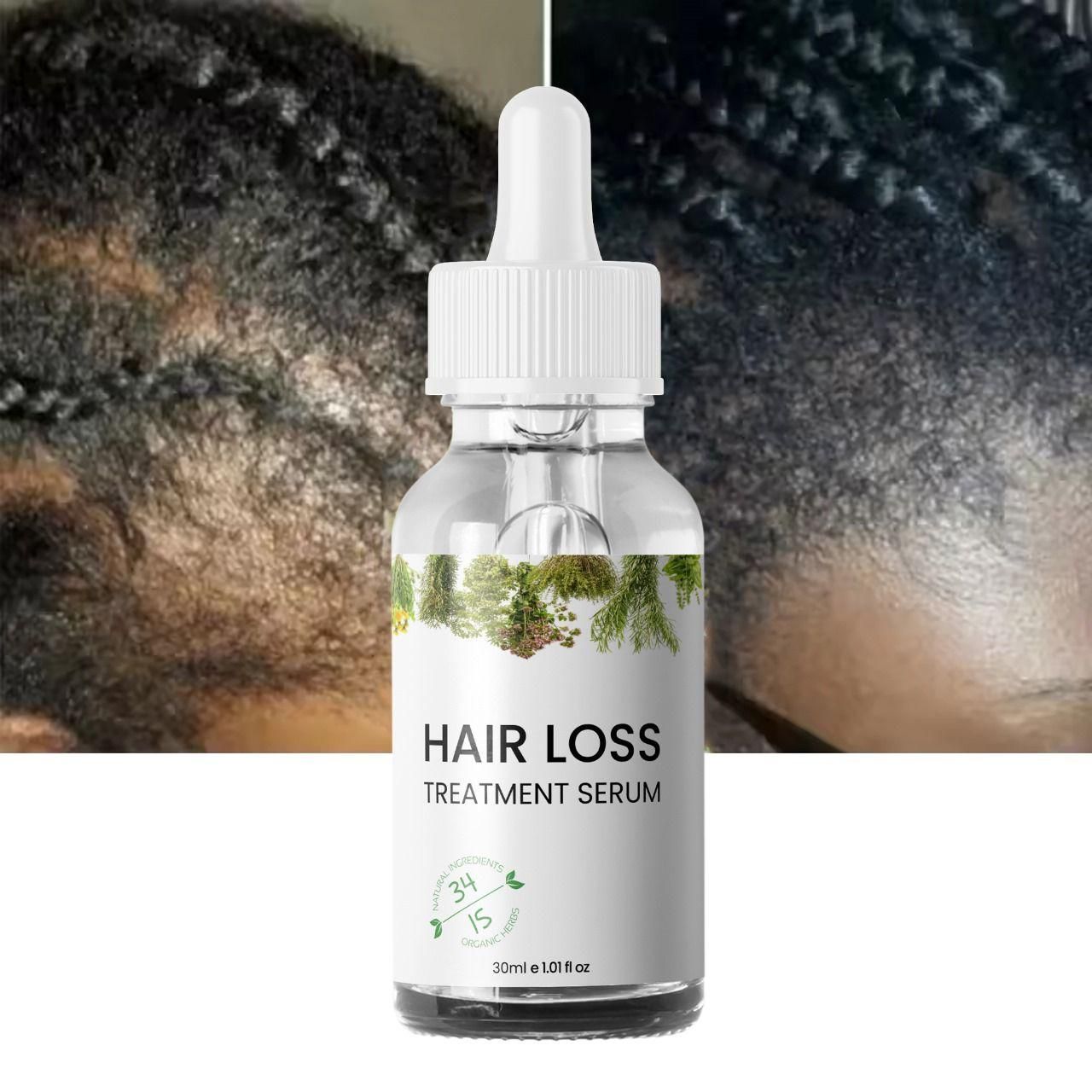 Hair Loss Treatment Serum Made of 34 Ingredients & 15 Herbs 30ml (Pack Of 2)