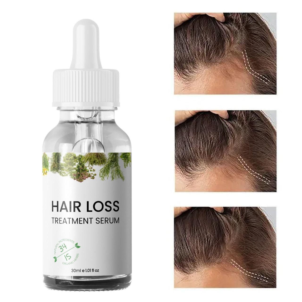 Hair Loss Treatment Serum Made of 34 Ingredients & 15 Herbs 30ml (Pack Of 2)